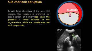 Ultrasound Imaging of Placental Abruption