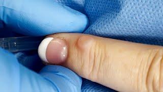 Wart or Cyst? Extracting a Bump on the Finger   CONTOUR DERMATOLOGY