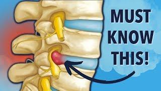 Why Herniated Disc Exercises Dont Work. Must Know This