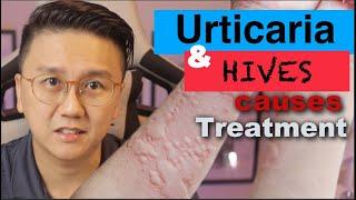 URTICARIA & HIVES - Causes and Treatment of Itchy Skin Rash