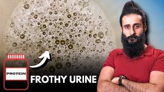 Whey Protein Caused FoamyFrothy Bubbles In Urine - Proteinuria?