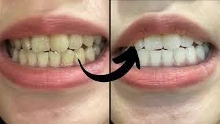 Teeth whitening treatment   teeth cleaning  teeth cleaning tartar 