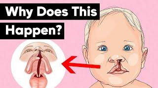 Cleft Lip & Cleft Palate Explained