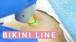 Laser Hair Removal Bikini THIS is how it works