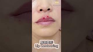 唇部塑形 Lip Contouring