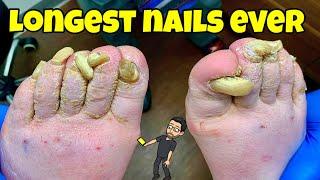 SUPER LONG TOENAILS CUTTING  AMAZING TRANSFORMATION