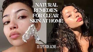 HOW TO MAINTAIN CLEAR SKIN WITHOUT SPENDING MONEY  15 tips and tricks for acne
