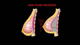Dual Plane Breast Augmentation Provides Nipple Lift Without the Scars