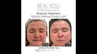 Nordys IPL Rosacea - Instagram Clip - Real You Clinic