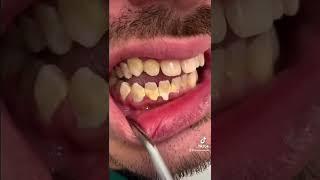 dental hygiene#tartar #dentist #fyp #tiktok #video #viral #trending #family #foryou #love #smile