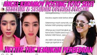 ANGEL KARAMOY PAMERKAN PERUBAHAN WAJAH USAI 3 BULAN OPLAS BEGINI TANGGAPAN NETTER  BEDANYA APA??