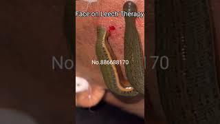 Face on Leech Therapy   Gujarat Hijama Therapy  #cuppingtherapy #leechtherapy #leeches #shorts