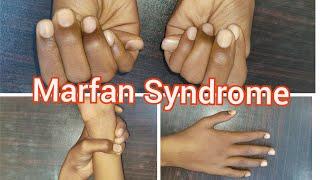 Marfan Syndrome  Clinical Signs