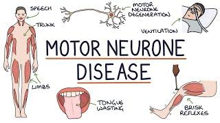 Understanding Motor Neurone Disease Amyotrophic Lateral Sclerosis