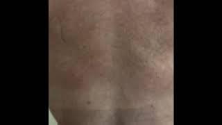 Renuvion J Plasma back treatment Drew Varano MD Washington DC 202-621-8675