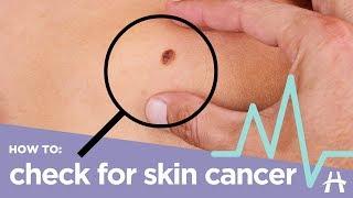 How to check for skin cancer