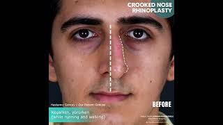 Crooked Nose Surgery Transformation Journey