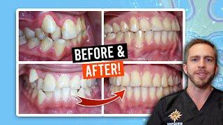 BRACES for MODERATE CROWDING BEFORE & AFTER