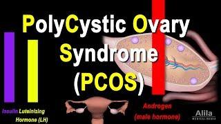 Polycystic Ovary Syndrome PCOS Pathology and Treatment Animation