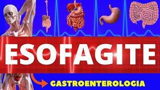 ESOFAGITE - O QUE É CAUSAS SINTOMAS DIAGNÓSTICO E TRATAMENTO - GASTROENTEROLOGIA