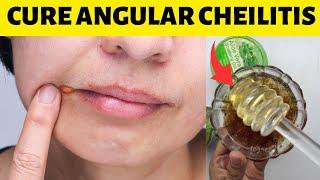 How To Get Rid Of Angular Cheilitis Overnight In Corner Of Mouth