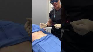 MUFFIN TOP Fat Melting AND Skin Tightening Treatment with Endolift by Dr. TJ Tsay @ Ageless MD