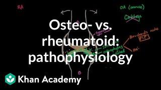 Osteoarthritis vs rheumatoid arthritis pathophysiology  NCLEX-RN  Khan Academy