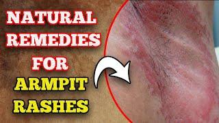 Underarms rash  solution ideas at home #underams  Health Educare