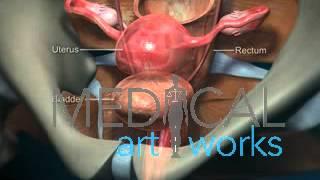 Medical Animation  Vaginal Prolapse - Cystocele fallen bladder