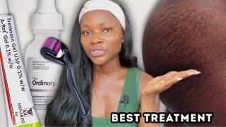 The best treatment for stretch marks ever  How to clear stretch marks fast at home #stretchmarks