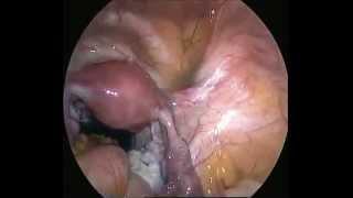 Laparoscopic Tubal Adhesiolysis for Infertility