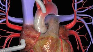 Heart Bypass Surgery CABG