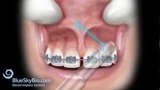 Patient Treatment Videos Frenectomy Laser