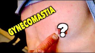 TEENAGER HAS A LUMP UNDER HIS NIPPLE... Gynecomastia  Dr. Paul