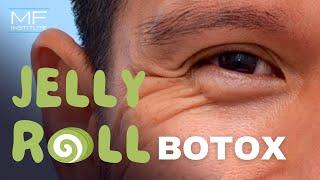 BOTOX® for Under Eye Bulging a.k.a. Jelly Roll BOTOX®  Mabrie Facial Institute in San Francisco CA