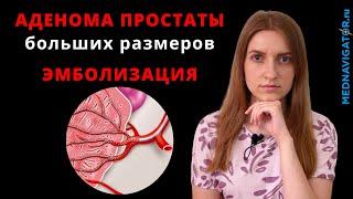 Лечение АДЕНОМЫ ПРОСТАТЫ больших размеров методом ЭМБОЛИЗАЦИИ артерий простаты  Mednavigator.ru