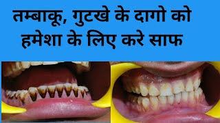 तम्बाकू गुटखा के दागो को हमेशा के लिए साफदांतों को कैसे सफ़ेद करेंTeeth cleaningTeeth whitening