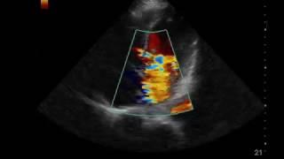 Severe Mitral Regurgitation in an Apical 4-Chamber View