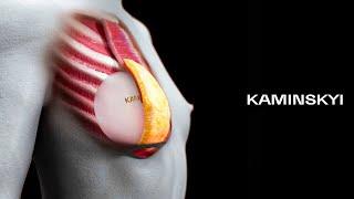 Round implants under the muscle  KAMINSKYI