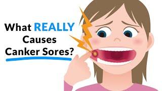 What REALLY Causes Canker Sores?