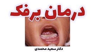 برفک دهان  oral thrush