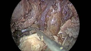 RT ICA SEGMENTS ENDOSCOPIC VIEW-dissection with DR IYPE CHERIAN