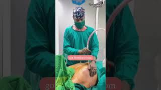 Freedom from Male Breasts - Gynecomastia Surgery