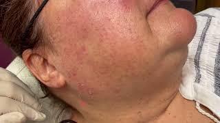 Removing Solar Lentignos & Seborrheic Keratosis SKs with Lasers