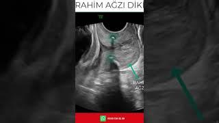 RAHİM AĞZI DİKİŞSERVİKAL SERKLAJ