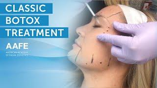 Full Face Botox Treatment  AAFE