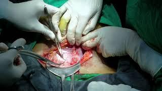 Previous Cesarean opening abdomen