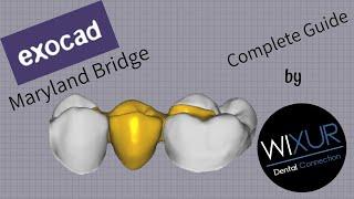 Exocad - Maryland Bridge metal-free