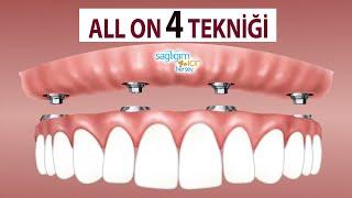 Diş İmplantlarında All On 4 Tekniği