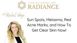 Sun Spots Melasma Red Acne Marks and How To Get Clear Skin Now with Rachel Varga